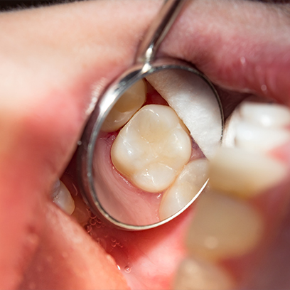 Teenage boy smiling after getting tooth colored fillings for cavity treatment for kids in Leesburg