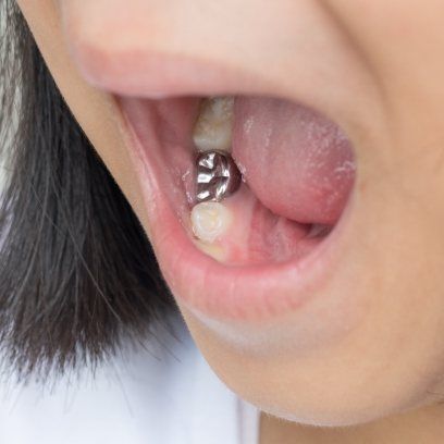 Close up of child's mouth with a silver dental crown