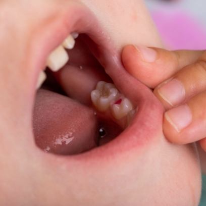 Young girl smiling in dental chair during baby root canal treatment in Leesburg