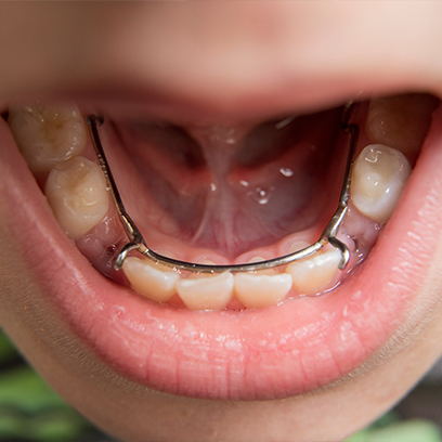 Close up of child's mouth with space maintainer