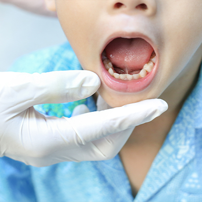 Pediatric dentist examining child who has tongue tie