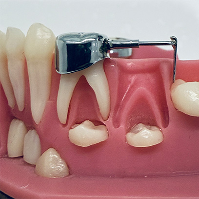 Close up of child's mouth with space maintainer