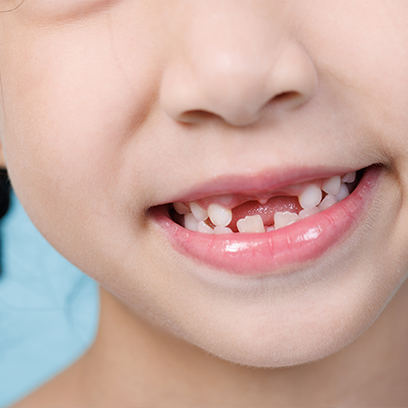 Young girl pointing to her smile before tooth extraction for children in Leesburg