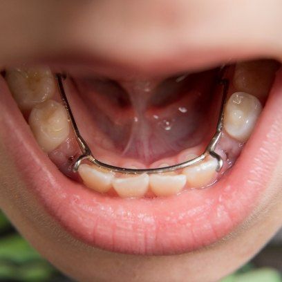 Close up of a child's mouth with a space maintainer