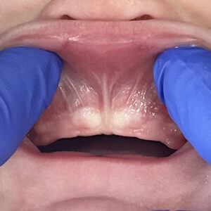 a lip tongue tie
